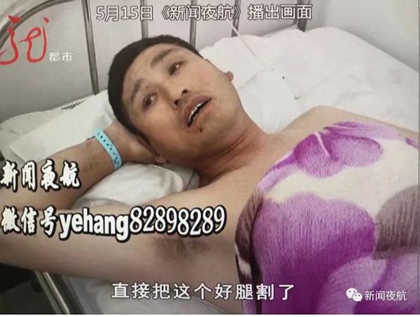 患者右腿做手术左腿被误割开 心病还需修养治